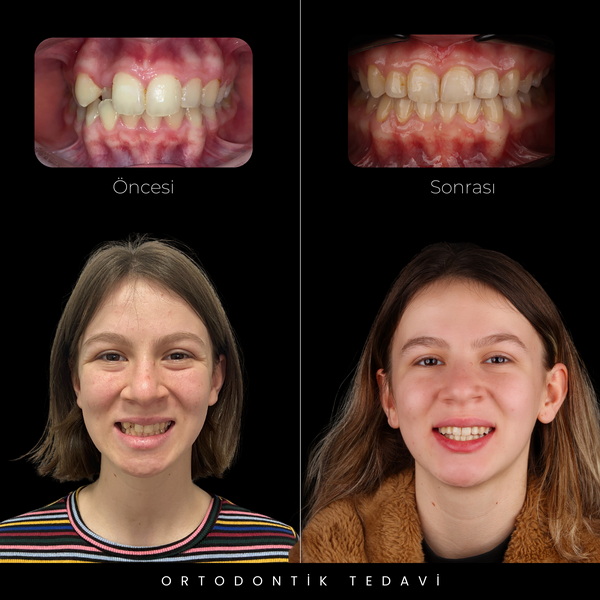 Orthodontic Treatment