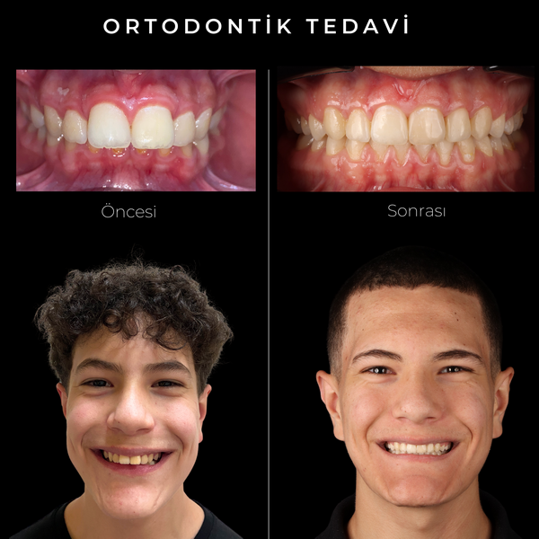 Orthodontic Treatment