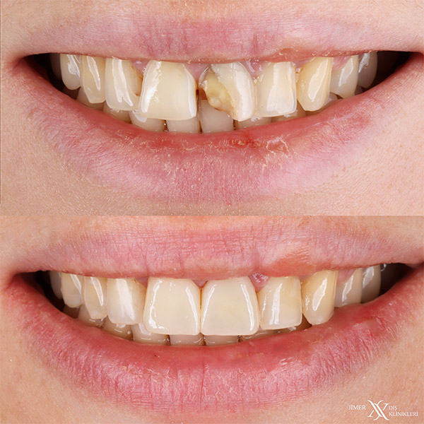 Glass Ceramic Veneer on Front Two Teeth