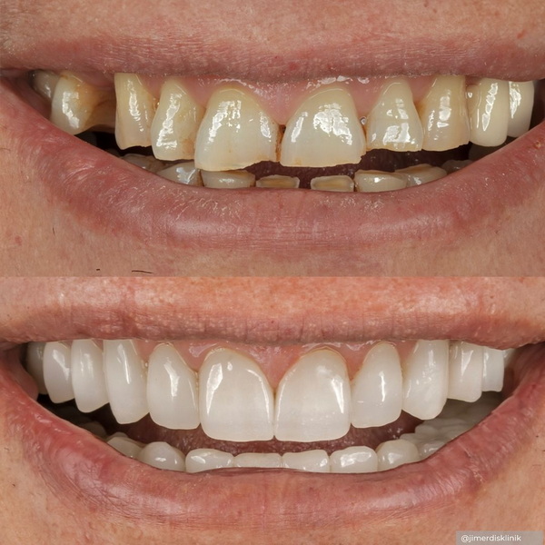 Full-Mouth Restoration