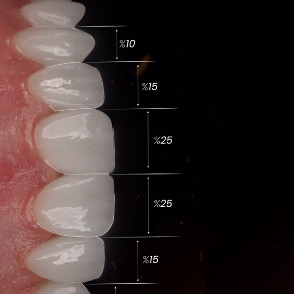 Natural, aesthetic, and flawless smile design with glass-ceramic laminates!