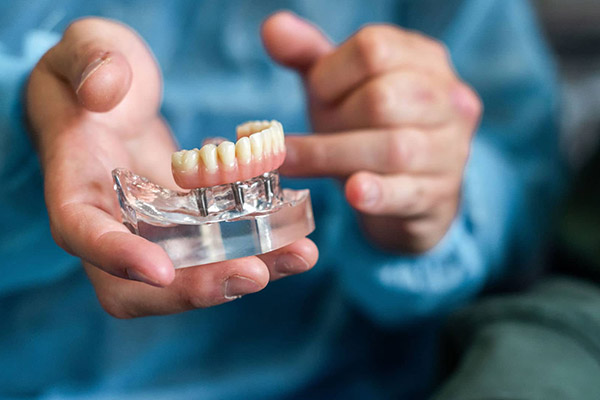 All-on-Four Implants All-on-Four Implants