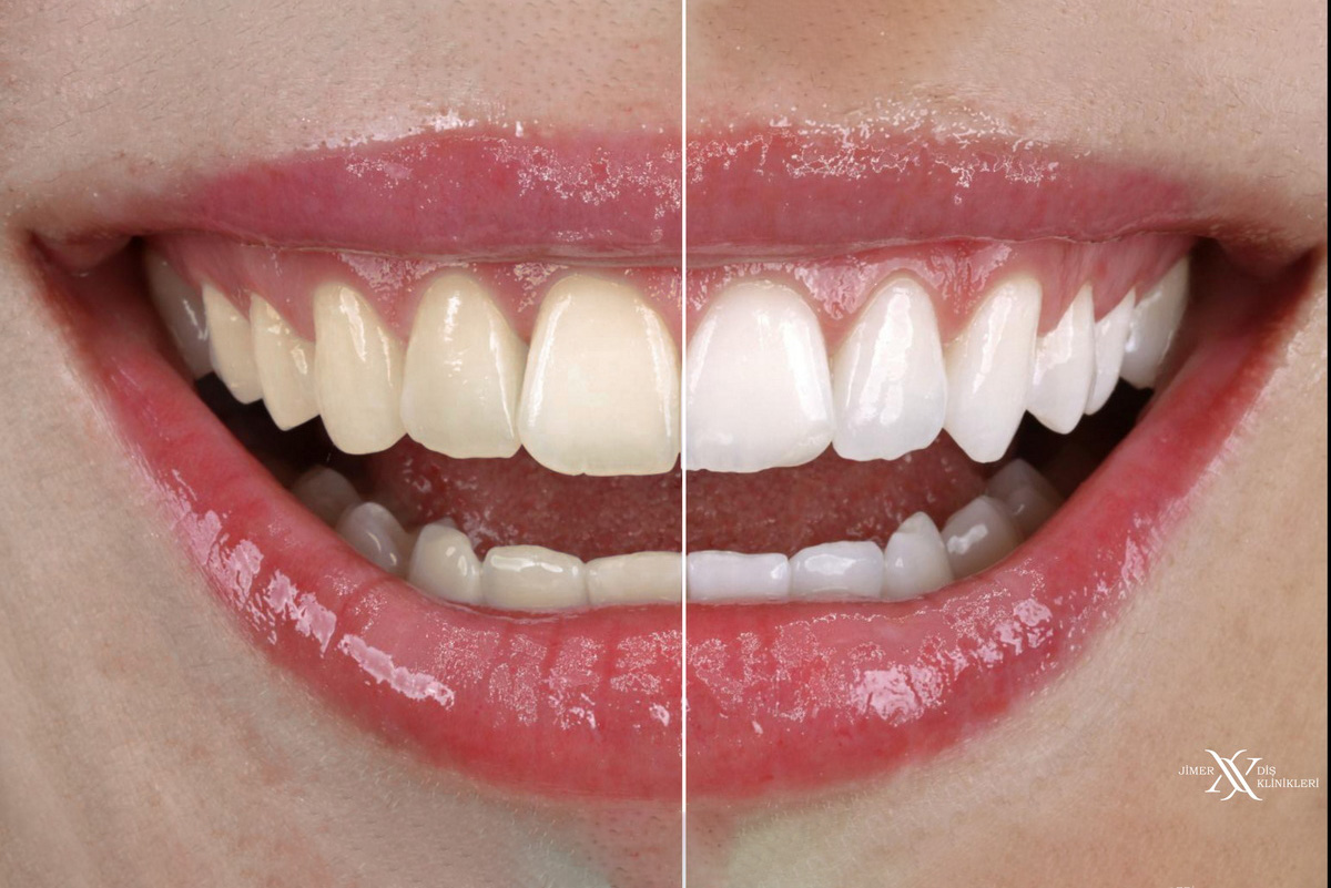 Teeth Whitening