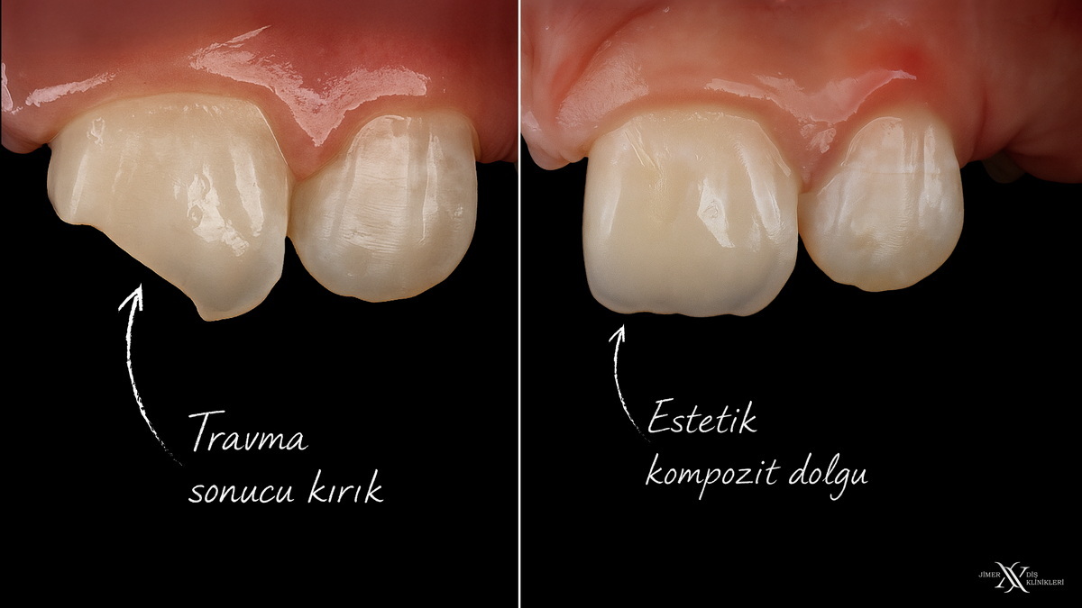 Composite Bonding Applications (Aesthetic Fillings)