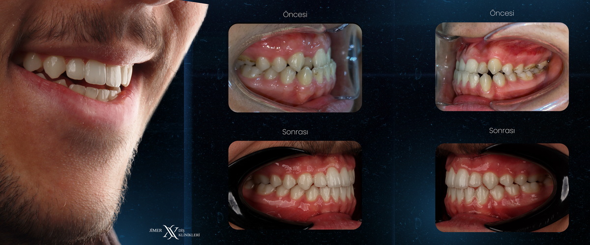 Orthodontic Treatment (Braces or Clear Alignment)