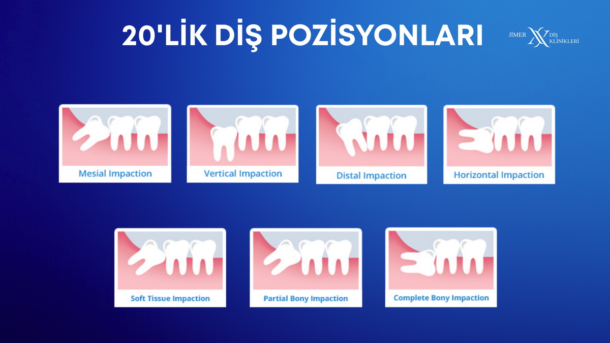 How are wisdom teeth positioned in the mouth?