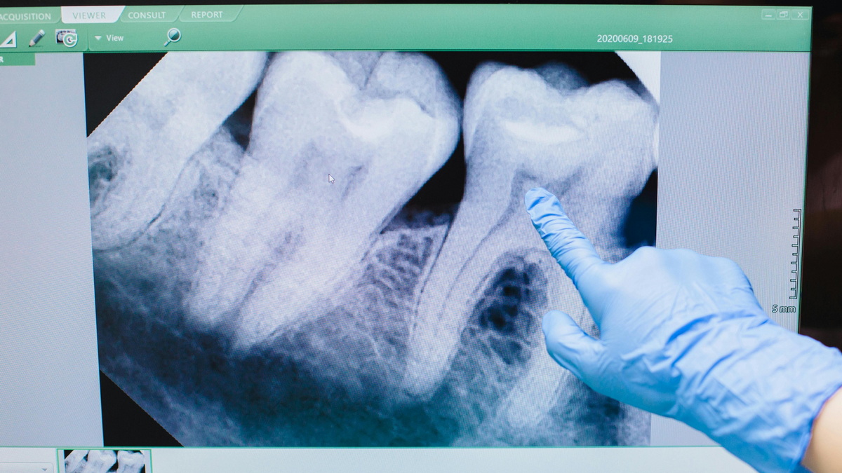 When Should Wisdom Teeth Be Extracted? Symptoms